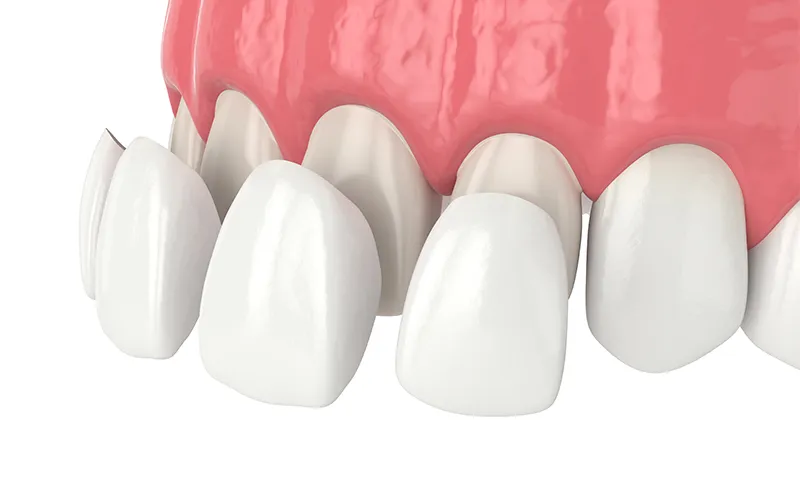 3D Printed Dental Veneers